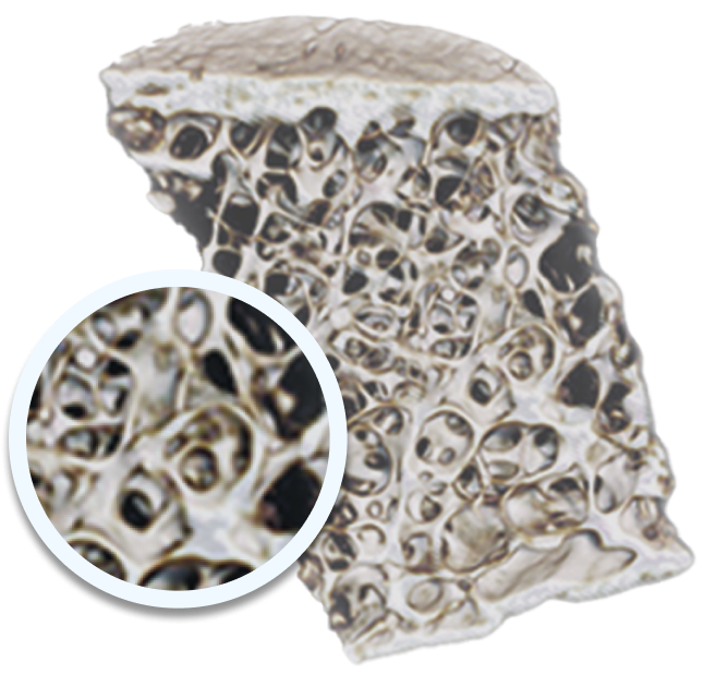 Untreated osteoporotic bone vs. osteoporotic bone with EVENITY® (romosozumab-aqqg)